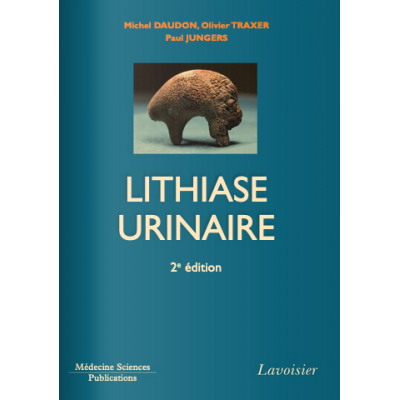 Lithiase urinaire