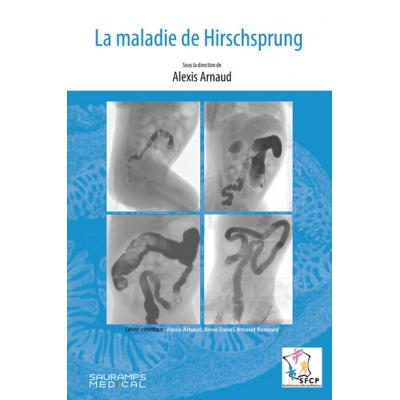 La maladie de Hirschsprung