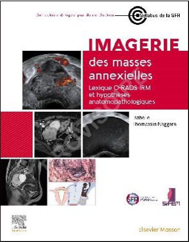 Imagerie des masses annexielles: Lexique O-RADS et corrélations radiopathologiques