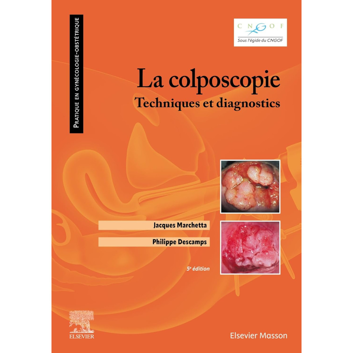 La colposcopie - Techniques et diagnostics