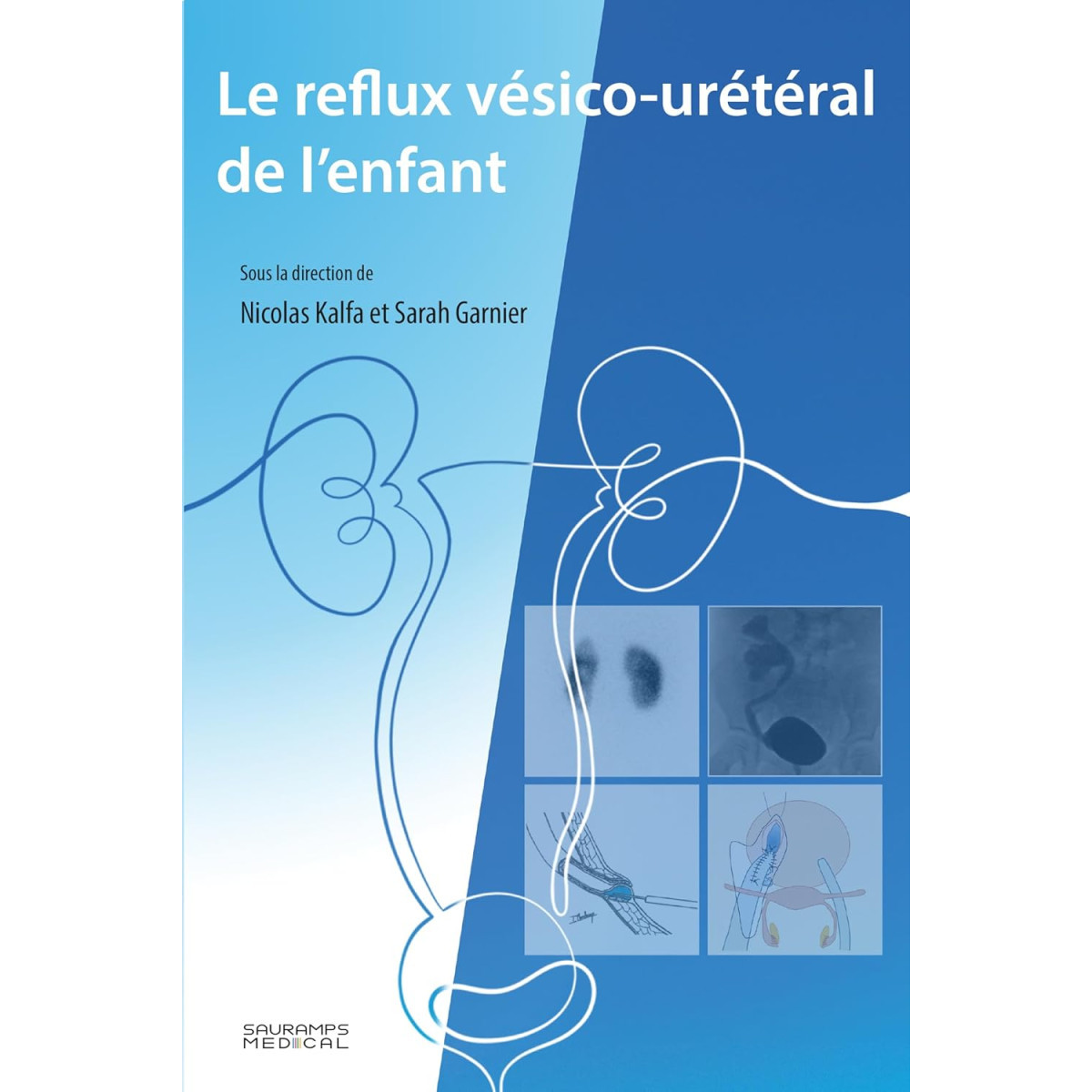 Le reflux vésico-urétéral de l'enfant