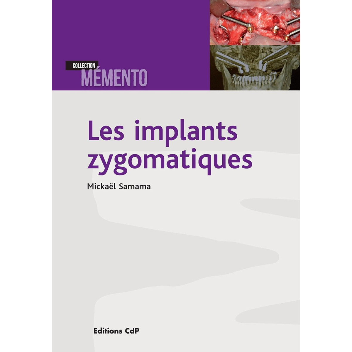 Les implants zygomatiques