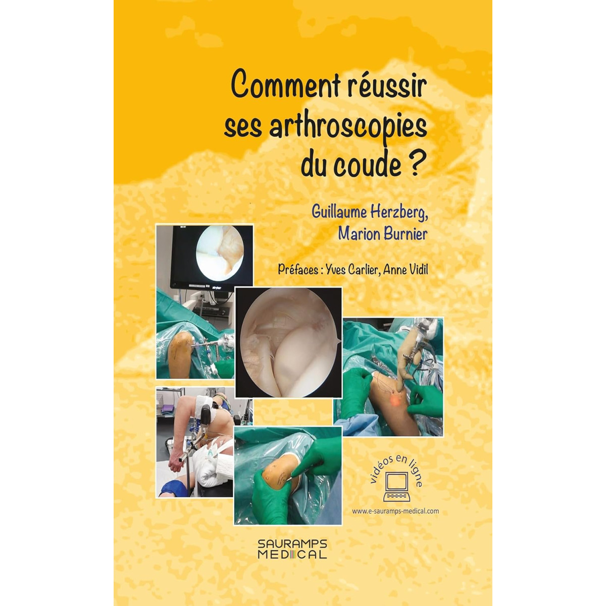 Comment réussir ses arthroscopies du coude ?